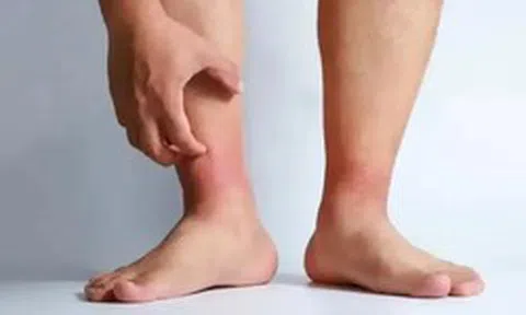 Chân sưng một bên, tuyệt đối đừng chủ quan: Cảnh báo dấu hiệu cục máu đông đang hình thành