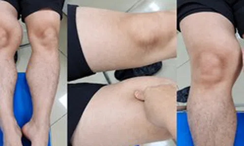 Đùi phình to như quả bóng suốt 1 năm, đi khám phát hiện ung thư hiếm gặp