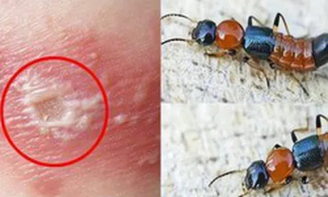 Kiến ba khoang "vào mùa", cẩn trọng dễ nhầm với zona thần kinh