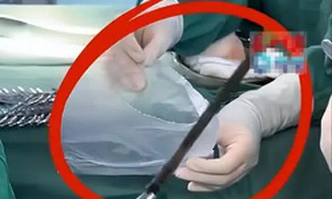 Người đàn ông nuốt chiếc đũa dài 12cm trong phút bốc đồng, 35 năm sau thứ bác sĩ lấy ra là…