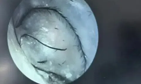 Người phụ nữ ngứa tai đi khám, bác sĩ phát hiện thứ bất ngờ bên trong