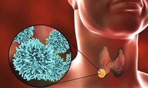 1 nam sinh mắc ung thư tuyến giáp di căn khi mới 15 tuổi: Vì sao bệnh ngày càng trẻ hóa?